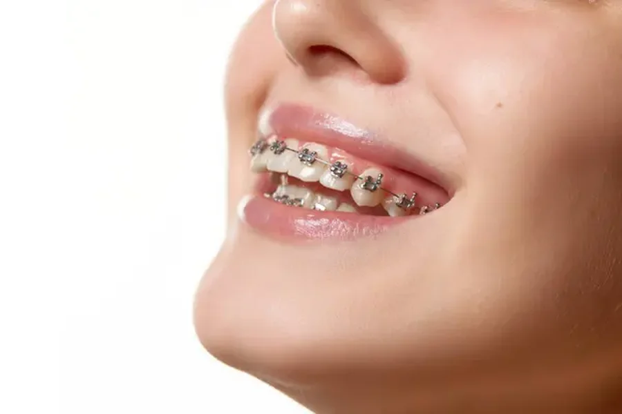 Braces and Orthodontic Options