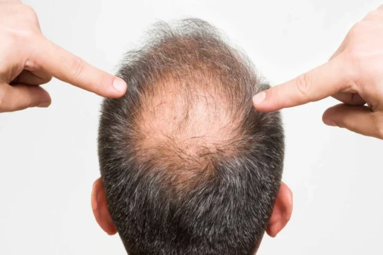 Hair Loss